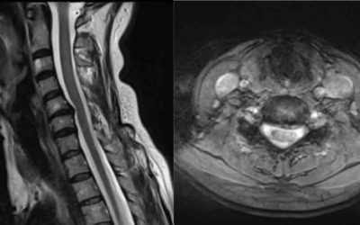 Artroplastia de columna cervical