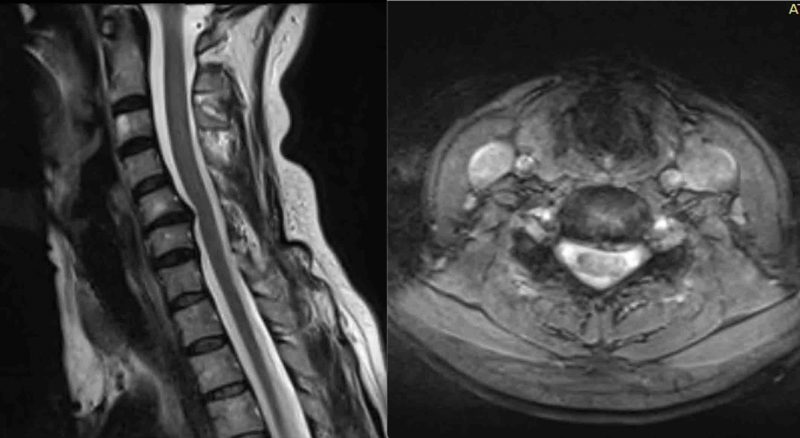 Artroplastia de columna cervical