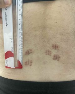 Cicatrices de artrodesis L5-S1 por endoscopia con una regla mostrando que las cicatrices apenas llegan a 1 centímetro.