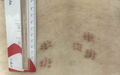 Fusión vertebral por endoscopia: técnica innovadora para el tratamiento de la columna