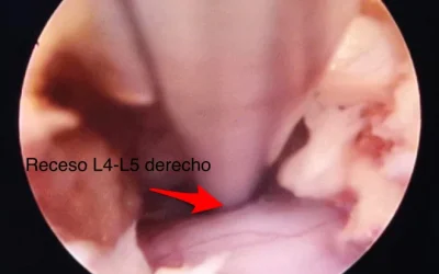 CIRUGIA ENDOSCOPICA COLUMNA LUMBAR