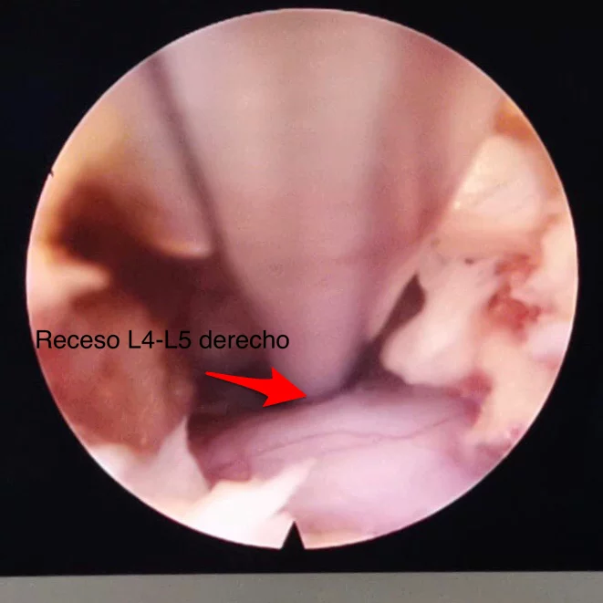 CIRUGIA ENDOSCOPICA COLUMNA LUMBAR