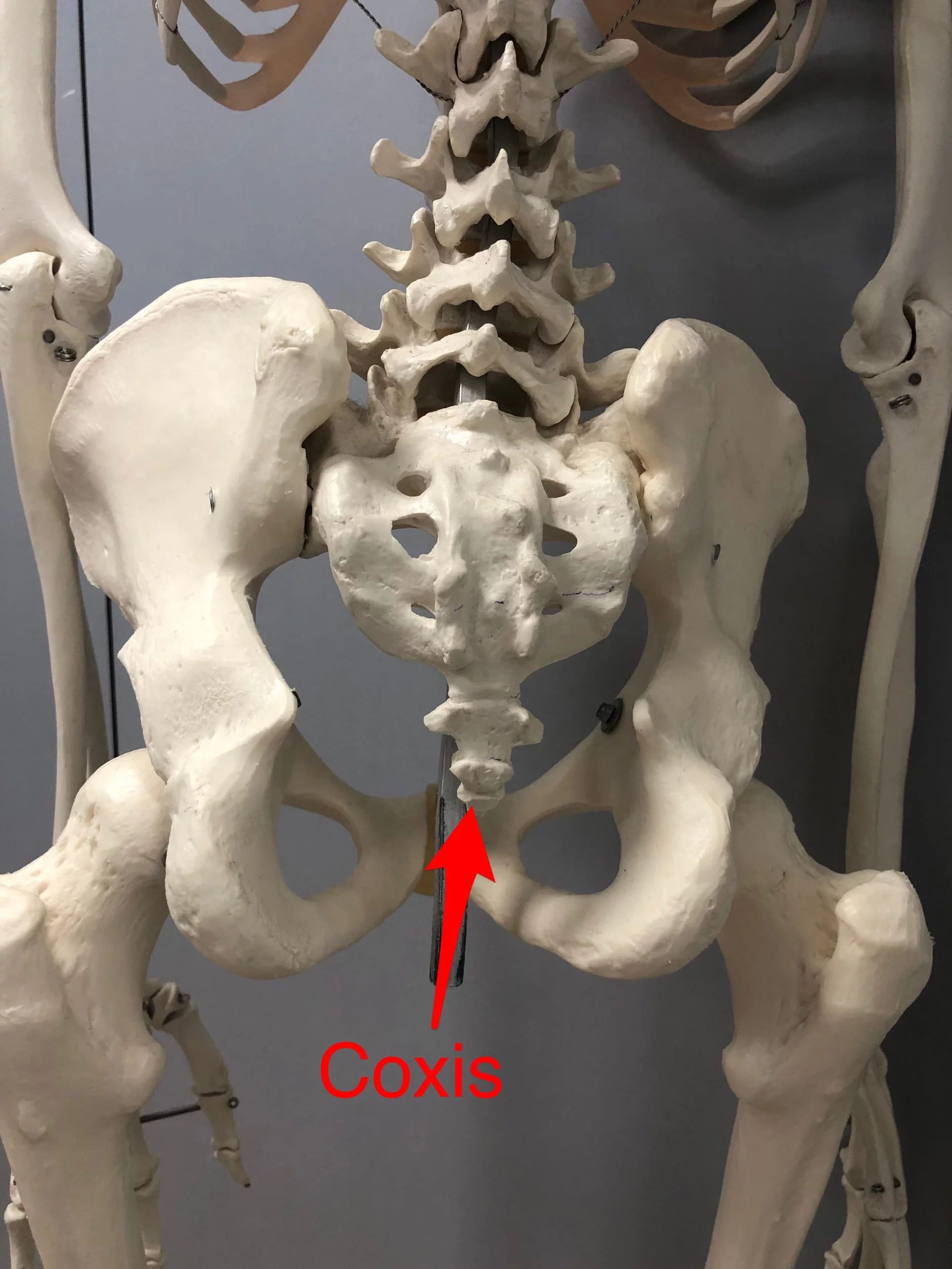COCCIGODINIA - Dr. Edgar Martín Castañeda