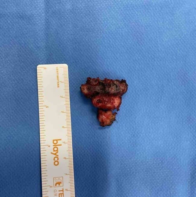 Imagen detallada de un coxis post-coxigectomía, mostrando los cambios estructurales después de la cirugía para el alivio de la coccigodinia