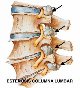 Ilustración detallada de una columna vertebral con signos de artrosis y estenosis, útil para comprender estas afecciones médicas