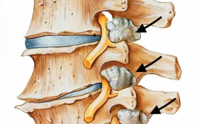 RECALIBRADO COLUMNA LUMBAR