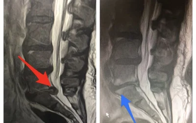 HERNIA DISCAL LUMBAR