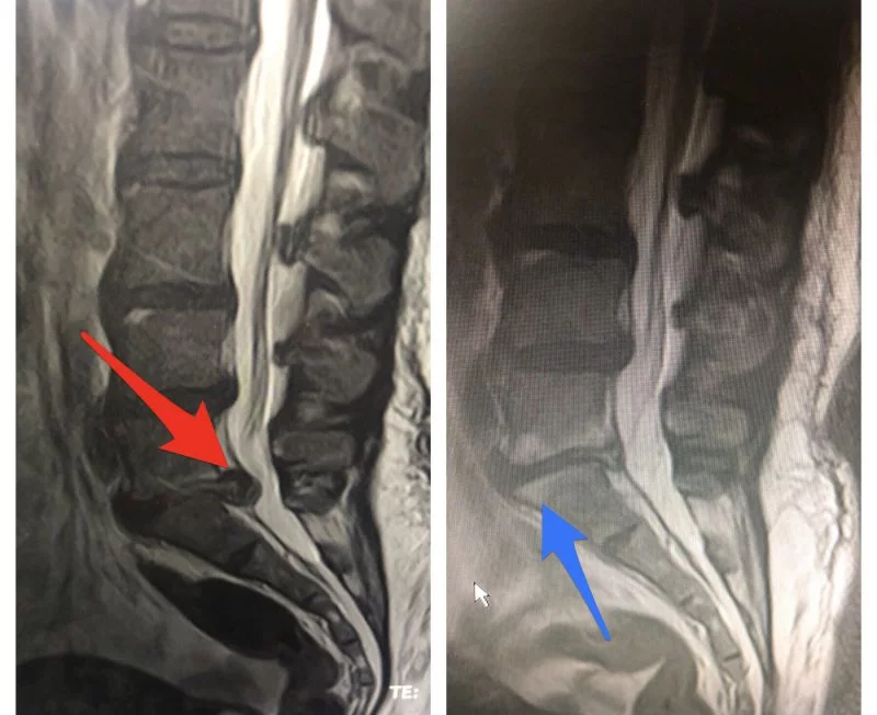 Hernia Discal Lumbar Dr Edgar Martín Castañeda