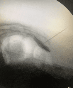 Imagen de radiografía que muestra el tratamiento de radiofrecuencia en el ganglio impar, enfocado en aliviar el dolor asociado con lesiones y condiciones crónicas de la columna.