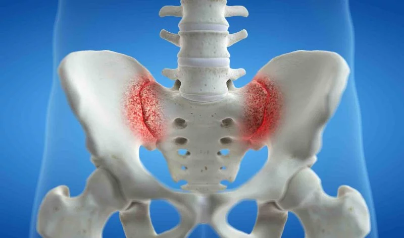 Imagen donde podemos ver inflamación de ambas articulaciones o sacroileitis bilateral